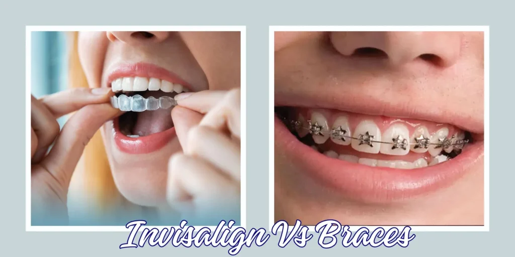 Invisalign Vs Braces